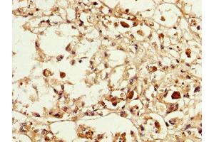 IHC image of ABIN7159260 diluted at 1:200 and staining in paraffin-embedded human melanoma performed on a Leica BondTM system. (MAGEA3 抗体  (AA 2-104))
