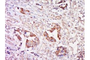 Paraformaldehyde-fixed, paraffin embedded human cervical cancer, Antigen retrieval by boiling in sodium citrate buffer (pH6) for 15min, Block endogenous peroxidase by 3% hydrogen peroxide for 30 minutes, Blocking buffer (normal goat serum) at 37°C for 20min, Antibody incubation with Rabbit Anti-Cathepsin L Polyclonal Antibody, Unconjugated  at 1:200 overnight at 4°C, followed by a conjugated secondary and DAB staining. (Cathepsin L 抗体  (AA 71-170))
