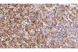 ABIN6279591 at 1/100 staining Human liver cancer tissue by IHC-P. (UNC5A 抗体  (Internal Region))