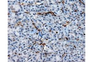 Immunohistochemical staining of paraffin-embedded Adenocarcinoma of ovary tissue using anti-CD36 mouse monoclonal antibody. (CD36 抗体)