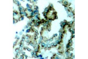 Immunohistochemistry of paraffin-embedded human lung carcinoma tissue, using Phospho-PKCalpha/beta II-T638/641 antibody (ABIN2987563).