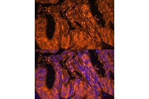 Immunofluorescence analysis of human colon carcinoma using Galectin 4/LG Polyclonal Antibody (ABIN7267339) at dilution of 1:100 (40x lens). (GAL4 抗体  (AA 1-100))