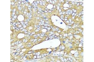 Immunohistochemistry of paraffin-embedded Human colon carcinoma using MLKL Polyclonal Antibody at dilution of 1:200 (40x lens). (MLKL 抗体)
