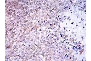 Immunohistochemical analysis of paraffin-embedded ovarian cancer tissues using NQO1 mouse mAb with DAB staining. (NQO1 抗体)