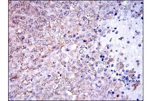 Immunohistochemical analysis of paraffin-embedded ovarian cancer tissues using NQO1 mouse mAb with DAB staining.