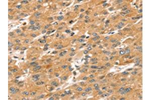 The image on the left is immunohistochemistry of paraffin-embedded Human liver cancer tissue using ABIN7192624(SPATA18 Antibody) at dilution 1/20, on the right is treated with synthetic peptide. (SPATA18 抗体)