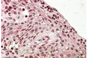 Immunohistochemistry (Paraffin-embedded Sections) (IHC (p)) image for anti-PR Domain Containing 1, with ZNF Domain (PRDM1) (Internal Region) antibody (ABIN615923) (PRDM1 抗体  (Internal Region))