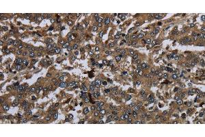 Immunohistochemistry of paraffin-embedded Human liver cancer using CD42b Polyclonal Antibody at dilution of 1:60 (CD42b 抗体)