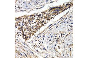 Immunohistochemistry of paraffin-embedded human esophagus cancer using FZR1 antibody at dilution of 1:200 (40x lens). (FZR1 抗体)