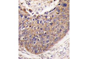 Formalin-fixed and paraffin-embedded human lung carcinoma tissue reacted with FXN antibody (C-term) (ABIN390377 and ABIN2840779) , which was peroxidase-conjugated to the secondary antibody, followed by DAB staining. (Frataxin 抗体  (C-Term))