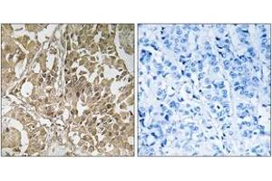 Immunohistochemistry analysis of paraffin-embedded human breast carcinoma tissue, using BUB1 Antibody. (BUB1 抗体  (AA 251-300))