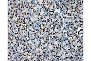 Immunohistochemical staining of paraffin-embedded Adenocarcinoma of colon tissue using anti-APP mouse monoclonal antibody. (APP 抗体)