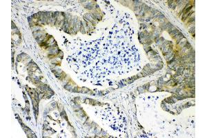 IHC analysis of AKR1B10 using anti- AKR1B10 antibody .