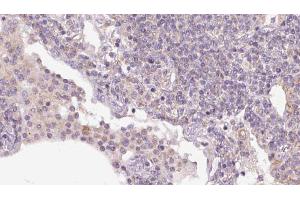 ABIN6273159 at 1/100 staining Human lymph cancer tissue by IHC-P. (SEC24A 抗体  (Internal Region))