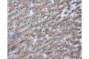 Immunohistochemical staining of paraffin-embedded Carcinoma of liver tissue using anti-NIT2 mouse monoclonal antibody. (NIT2 抗体)