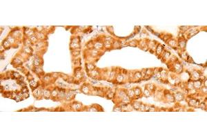 Immunohistochemistry of paraffin-embedded Human thyroid cancer tissue using ZMYND10 Polyclonal Antibody at dilution of 1:35(x200) (ZMYND10 抗体)