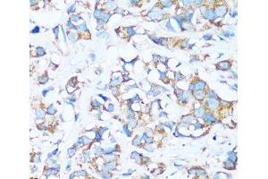 Immunohistochemistry of paraffin-embedded Human breast cancer using ARHGEF5 Polyclonal Antibody at dilution of 1:100 (40x lens). (ARHGEF5 抗体)