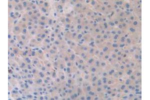 IHC-P analysis of Human Liver Cancer Tissue, with DAB staining. (SLIT1 抗体  (AA 647-835))
