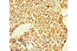 Immunohistochemistry of paraffin-embedded human melanoma using ABIN7145605 at dilution of 1:100 (MUTED 抗体  (AA 2-187))