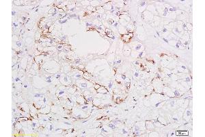 Formalin-fixed and paraffin embedded human colon carcinoma tissue labeled with Anti VEGF Polyclonal Antibody,Unconjugated (ABIN674829) at 1:200 followed by conjugation to the secondary antibody and DAB staining. (VEGF 抗体)