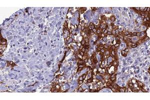ABIN6266638 at 1/100 staining Human Head and neck cancer tissue by IHC-P. (Synaptophysin 抗体  (Internal Region))