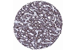 Hepatocellular carcinoma with strong Hepatocyte immunostaining of all tumor cells (Hepatocyte Specific Antigen 抗体)