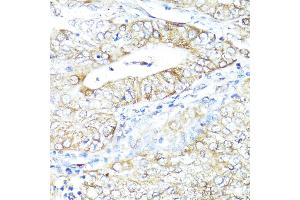Immunohistochemistry of paraffin-embedded Human uterine cancer using IFN antibody (ABIN3015562, ABIN3015563, ABIN3015564 and ABIN6218872) at dilution of 1:100 (40x lens).