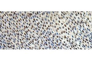 Immunohistochemistry of paraffin-embedded Human lung cancer tissue using DDX39A Polyclonal Antibody at dilution of 1:65(x200) (DDX39 抗体)