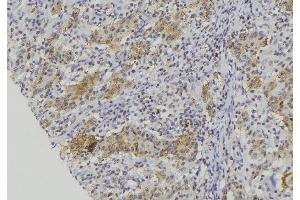 ABIN6273134 at 1/100 staining Human lung cancer tissue by IHC-P. (CMA1 抗体  (C-Term))