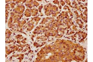 IHC image of ABIN7157587 diluted at 1:400 and staining in paraffin-embedded human pancreatic cancer performed on a Leica BondTM system. (KIF13A 抗体  (AA 1383-1537))