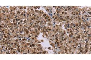 Immunohistochemistry of paraffin-embedded Human liver cancer tissue using MRGPRX1 Polyclonal Antibody at dilution 1:40 (MRGPRX1 抗体)