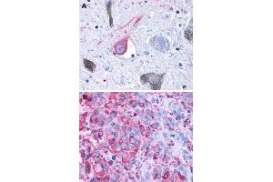 Immunohistochemical (Formalin/PFA-fixed paraffin-embedded sections) staining in human brain, substantia nigra (A) and human melanoma (B) with GPR50 polyclonal antibody . (GPR50 抗体  (C-Term))