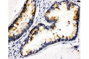 IHC-P: Kallikrein 6 antibody testing of human intestinal cancer tissue