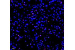 Immunofluorescence of paraffin embedded human liver cancer using RBM8A (ABIN7075478) at dilution of 1: 300 (400x lens) (RBM8A 抗体)