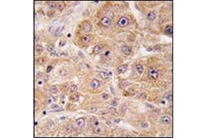 Formalin-fixed and paraffin-embedded human hepatocarcinoma tissue reacted with UVRAG Antibody , which was peroxidase-conjugated to the secondary antibody, followed by DAB staining. (UVRAG 抗体  (C-Term))