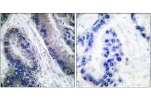 Immunohistochemistry analysis of paraffin-embedded human lung carcinoma, using IL-1 beta (Cleaved-Asp210) Antibody. (IL-1 beta 抗体  (Cleaved-Asp210))