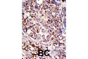 Formalin-fixed and paraffin-embedded human cancer tissue reacted with USP3 polyclonal antibody  , which was peroxidase-conjugated to the secondary antibody, followed by DAB staining. (USP3 抗体  (C-Term))