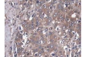 Detection of MAP4 in Human Prostate cancer Tissue using Polyclonal Antibody to Microtubule Associated Protein 4 (MAP4) (MAP4 抗体  (AA 243-549))