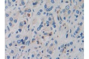 Detection of DDX58 in Human Prostate cancer Tissue using Polyclonal Antibody to Probable ATP-dependent RNA Helicase DDX58 (DDX58) (DDX58 抗体  (AA 550-776))