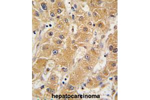 Formalin-fixed and paraffin-embedded human hepatocarcinomareacted with APOA5 polyclonal antibody , which was peroxidase-conjugated to the secondary antibody, followed by AEC staining. (APOA5 抗体  (N-Term))