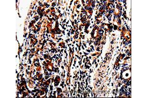 Immunohistochemistry of Human lung cancer using ACSBG2 Polyclonal Antibody at dilution of 1:60 (ACSBG2 抗体)