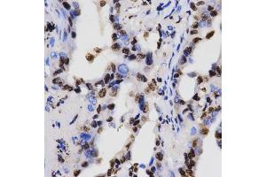 Immunohistochemistry of paraffin-embedded human lung cancer using Dimethyl-Histone H3-K4 antibody (ABIN5969803) at dilution of 1/200 (40x lens). (Histone 3 抗体  (H3K4me2))