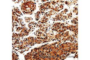 Immunohistochemistry of Human liver cancer using APLP1 Polyclonal Antibody at dilution of 1:25 (APLP1 抗体)