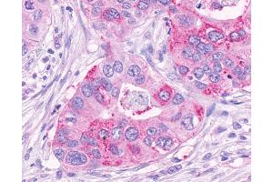 Anti-NPFF2 / NPFFR2 antibody IHC of human Pancreas, Carcinoma. (NPFFR2 抗体  (Extracellular Domain))