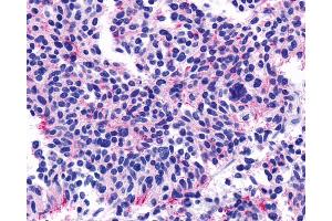 Anti-CHRM5 / M5 antibody IHC of human Lung, Small Cell Carcinoma. (CHRM5 抗体  (Cytoplasmic Domain))