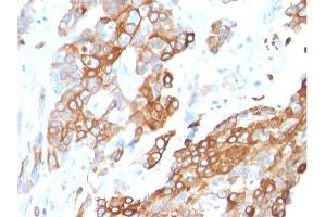 Formalin-fixed, paraffin-embedded human Breast Carcinoma stained with Heregulin-1 Mouse Monoclonal Antibody (NRG1/2710). (Neuregulin 1 抗体  (AA 21-242))