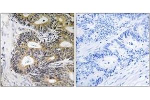 Immunohistochemistry analysis of paraffin-embedded human colon carcinoma, using TRAPPC6A Antibody. (TRAPPC6A 抗体  (AA 31-80))