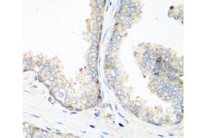 Immunohistochemistry of paraffin-embedded Human prostate using NEDD4 Polyclonal Antibody at dilution of 1:200 (40x lens). (NEDD4 抗体)