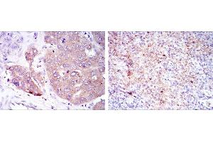 Immunohistochemical analysis of paraffin-embedded liver cancer (left) and submaxillary tumor (right) using EIF4E mouse mAb with DAB staining. (EIF4E 抗体)