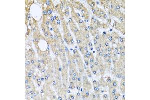 Immunohistochemistry of paraffin-embedded human liver injury using UQCRC2 antibody (ABIN5972314) at dilution of 1/100 (40x lens). (UQCRC2 抗体)